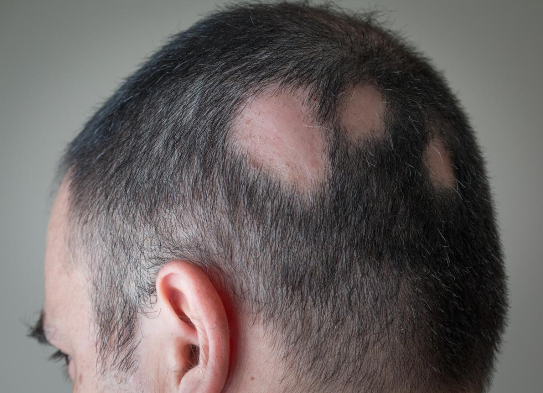 Alopesi Areata