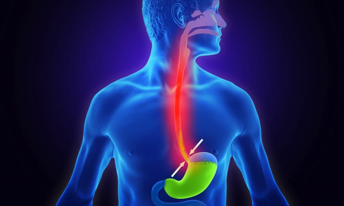 Barrett Özofagusu (Barrett Metaplazisi)